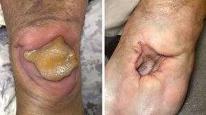 ulcer characteristics differentiation guide