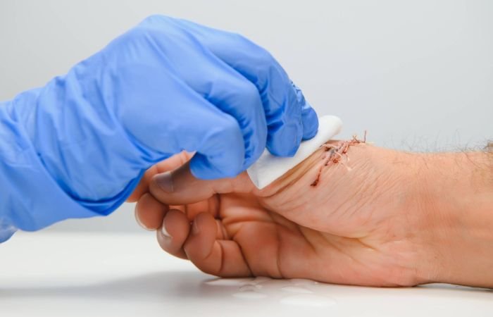 suture-wound-on-hand-pain-of-accident